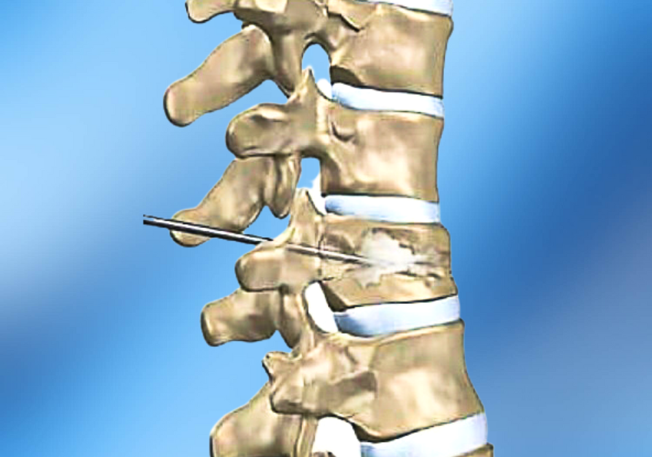 vertebroplastia